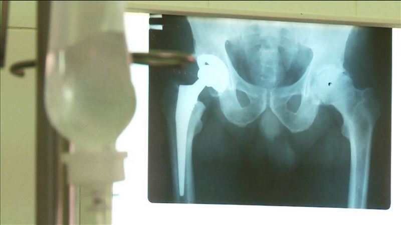 В Тюмени пациенту установили протез бедренной кости, созданный на  3D-принтере