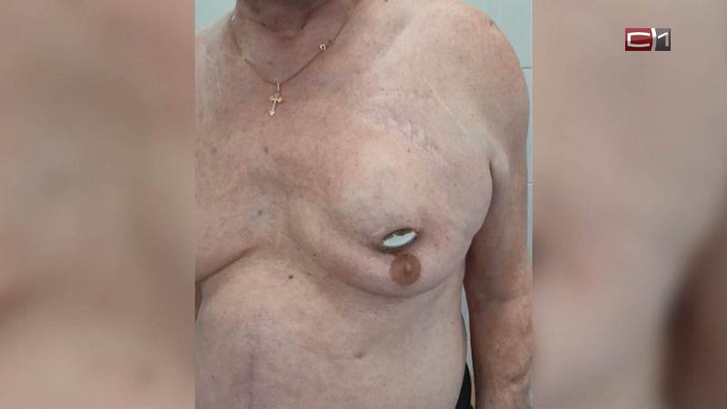 Тюменские хирурги прооперировали мужчину с вышедшим наружу кардиостимулятором