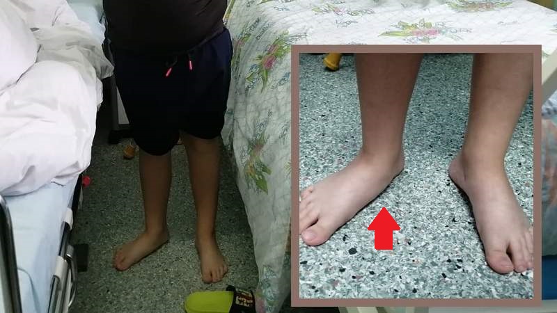 В травмцентре Сургута прооперировали 9-летнего пациента с патологией стоп