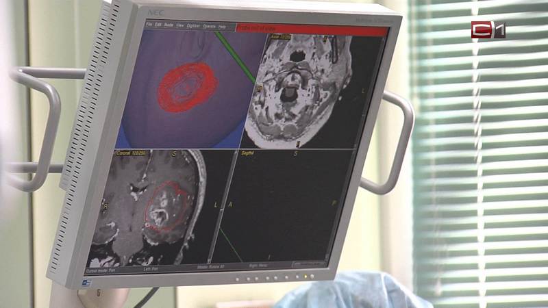 Сургутские врачи провели операцию на «открытом» мозге пациентки из Китая