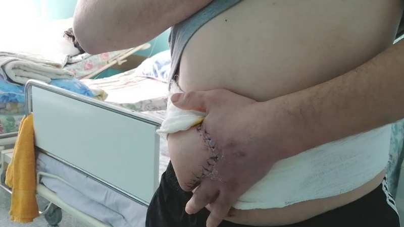 В сургутском травмцентре пациенту пришили руку к животу
