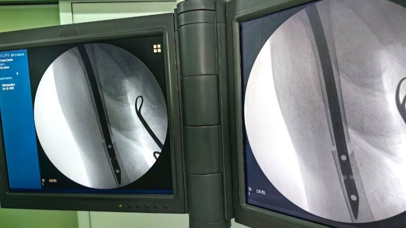 Врачи Сургутской травмбольницы прооперировали 92-летнюю пациентку с переломом