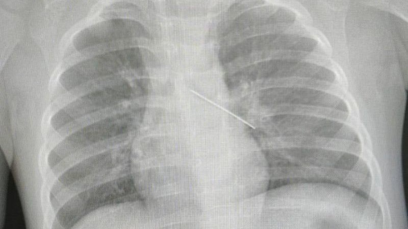 В Сургуте медики спасли ребенка, проглотившего английскую булавку